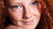 Da li pege na licu mogu da ukažu na ozbiljnije stanje kože?